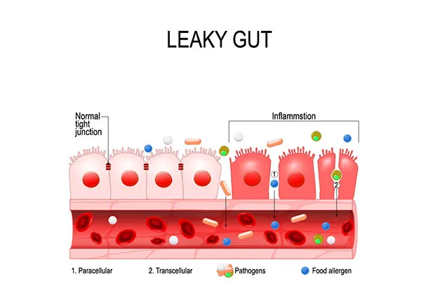 Leaky gut